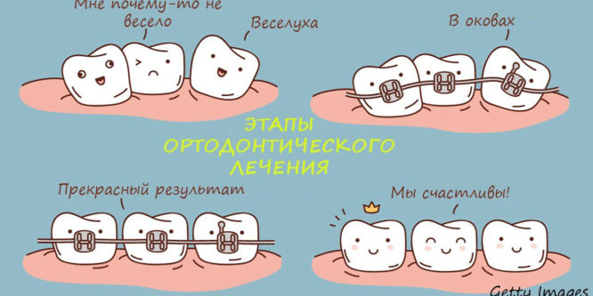 11 фактов о брекетах, которые нужно знать перед их установкой