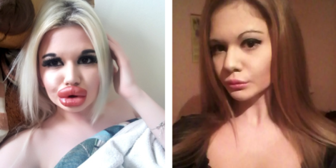 24-летняя болгарка мечтает иметь самые большие губы в мире