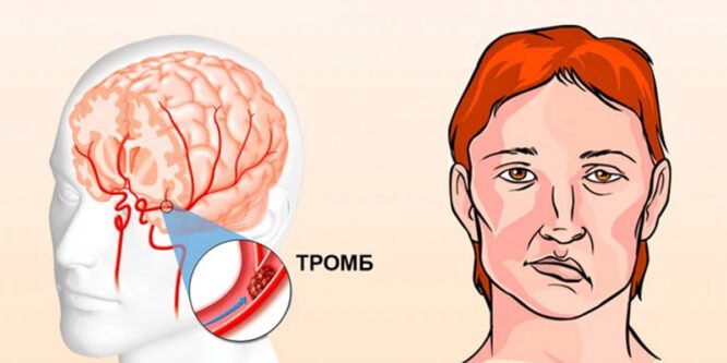 Вот 5 опасных признаков инсульта, на которые стоит обратить внимание